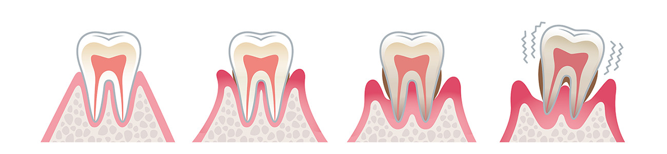 歯周病の進行
