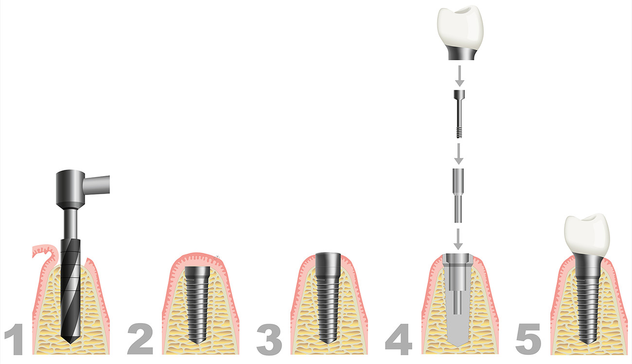 インプラント治療の流れ