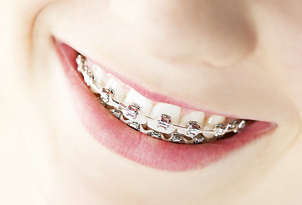 歯列矯正治療中の女性